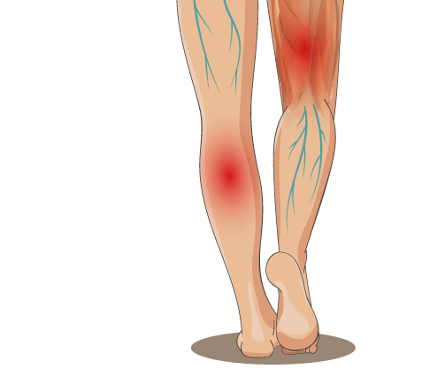 SteckbriefThrombose_Wie lässt sich eine Thrombose erkennen? - Angehörige  Pflegen